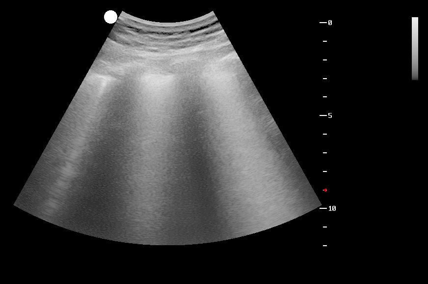 Plicní ultrazvuk