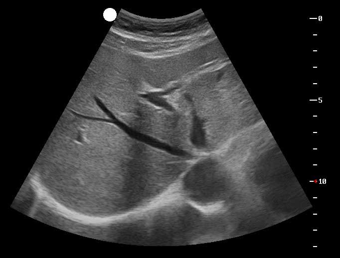 Abdominální ultrazvuk